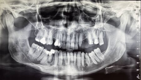 Orthopantomography of an adult patient, dentistryの写真素材