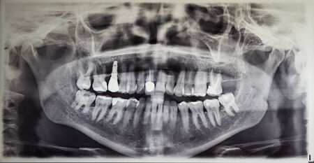 Orthopantomography of an adult patient, dentistryの写真素材