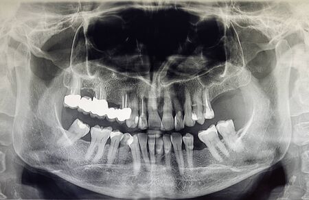 Orthopantomography of an adult patient, dentistryの写真素材