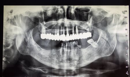 Orthopantomography of an adult patient, dentistry