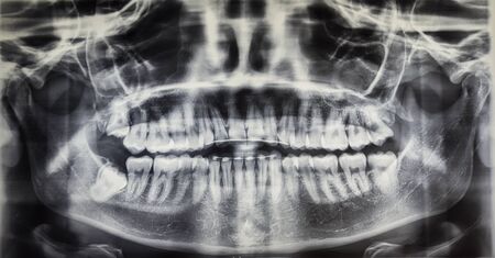 Orthopantomography of an adult patient, dentistry