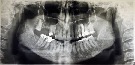 Orthopantomography of an adult patient,digital radiographic acquisitionの写真素材