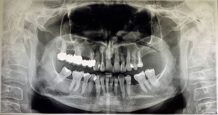 Orthopantomography of an adult patient,digital radiographic acquisitionの写真素材