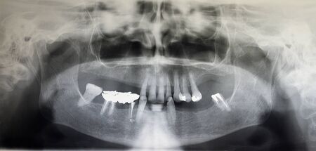 Orthopantomography of an adult patient,digital radiographic acquisitionの写真素材