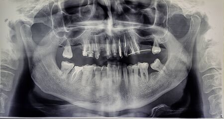 Orthopantomography of an adult patient,digital radiographic acquisitionの写真素材