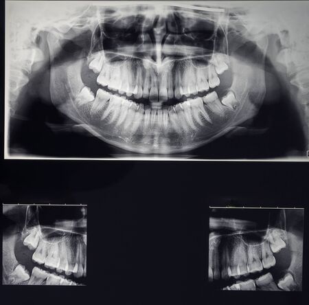 odontostomalogical radiographs, digital orthopantomography for dental diagnosisの写真素材