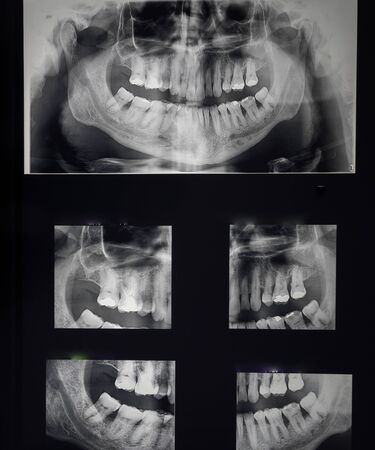 odontostomalogical radiographs, digital orthopantomography for dental diagnosisの写真素材