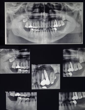 odontostomalogical radiographs, digital orthopantomography for dental diagnosisの写真素材