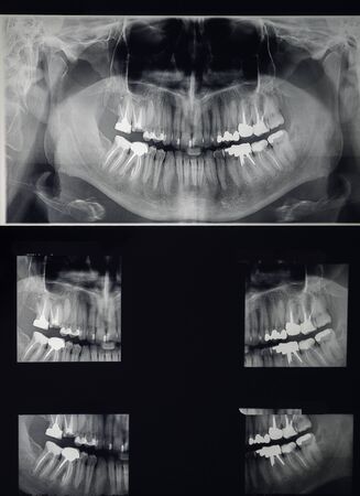 odontostomalogical radiographs, digital orthopantomography for dental diagnosisの写真素材