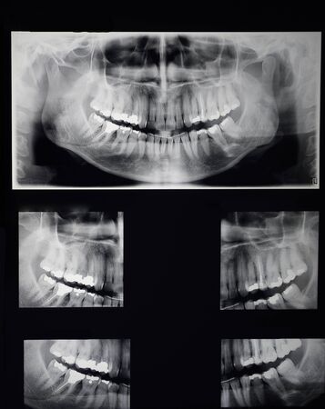 odontostomalogical radiographs, digital orthopantomography for dental diagnosisの写真素材
