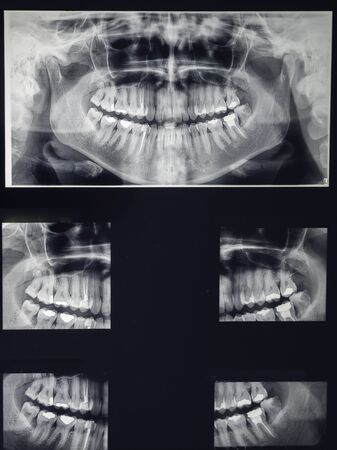 odontostomalogical radiographs, digital orthopantomography for dental diagnosisの写真素材