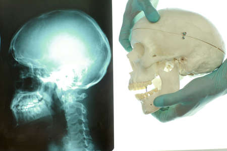 skull and neck  at x-ray film viewer on the left , hands in gloves holding model of skull bones...