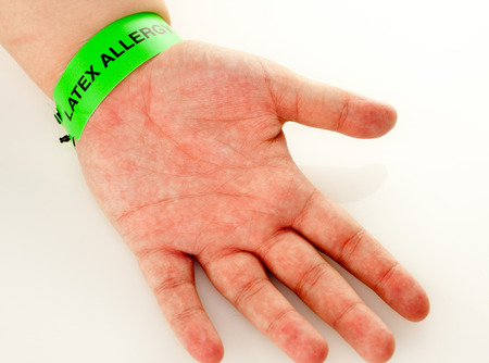 A hand with a latex allergy bracelet around wristの写真素材