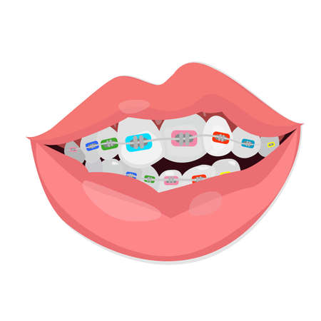 Teeth braces vector illustrationのイラスト素材