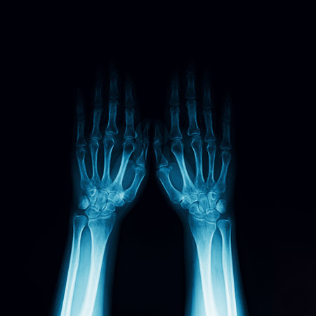 Symmetrical X-ray radiograph of two human wrists and hands with forearms on black background. Medical image showing bones of the carpus, metacarpals, phalanges, radius, and ulnaの写真素材