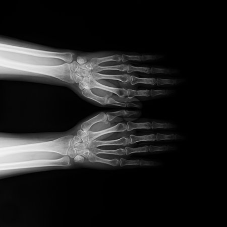 Symmetrical X-ray radiograph of two human wrists and hands with forearms on black background....