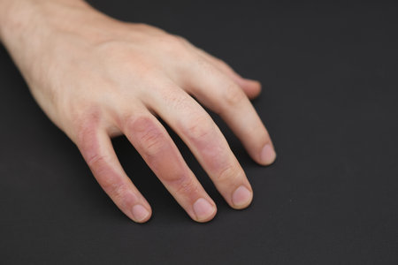Man with burn on her hand, closeup. Burn blister on the hand. Hand male with blisters due to burns.