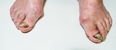 Close-up view of adult feet affected by onycholysis, where the toenails appear separated from the...