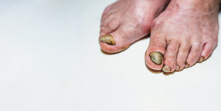 Close-up view of adult feet affected by onycholysis, where the toenails appear separated from the...