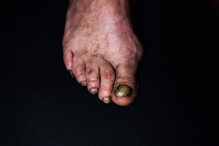 A close-up toenail suffering from onycholysis, characterized by its separation from the nail bed