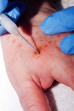 Microsurgery: Removing skyn deseas