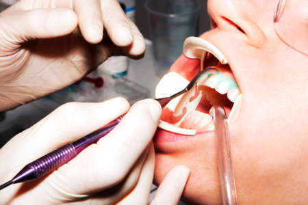 Teeth whitening treatment
