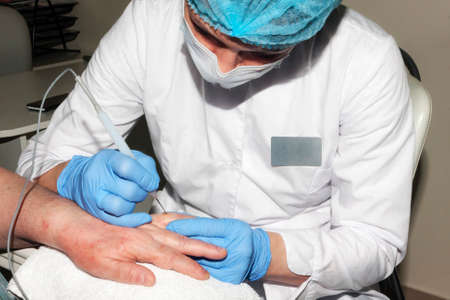 Microsurgery: Doctor removes skin diseasesの写真素材