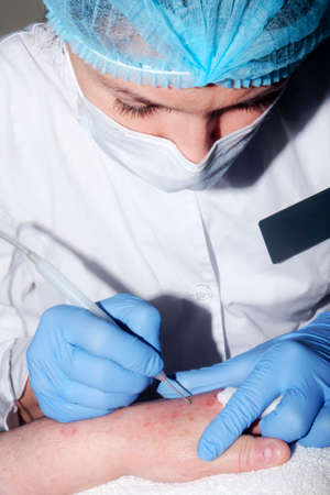 Micro surgery: Doctor removes skin diseasesの写真素材