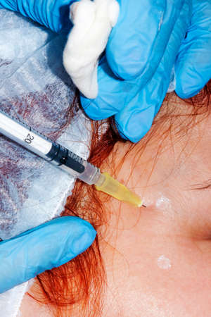 Anti aging procedure : Dermatologist performs injection of botulinum toxin in face (selective focus)の写真素材