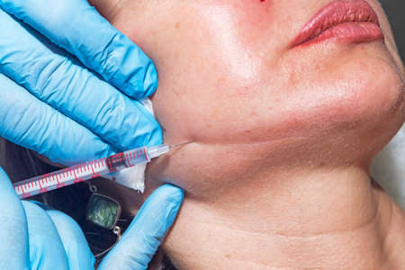 Dermatologist cosmetologist applies cosmetic injection of botulinum toxin on a middle-aged patient at beauty clinic の写真素材