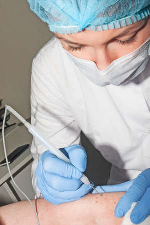 Dermatologist surgeon removes skin diseases with electrocoagulatorの写真素材