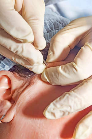 Dermatologist performs path to enter lines of poly milk acid for face lifting procedure- selective...
