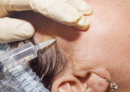 Dermatologist performs local facial anesthesia to prepare patient for face lifting with poly lactic acid line - Selective focusの写真素材