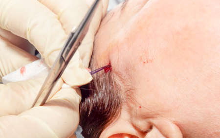 Dermatologist surgeon pulls filaments to perform facial lifting with polylactic acid filaments - Selective focusの写真素材