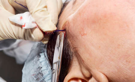 Dermatologist surgeon pulls filaments to perform facial lifting with polylactic acid filaments - Selective focusの写真素材