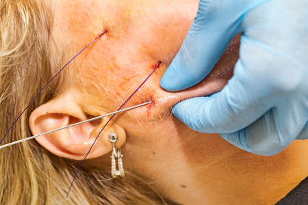 Filaments of polylactic acid applied in the face - Selective focusの写真素材