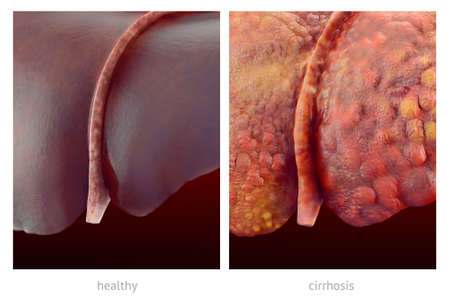 Realistic illustration of comparsion of healthy and sick (cirrhosis) human liversの写真素材