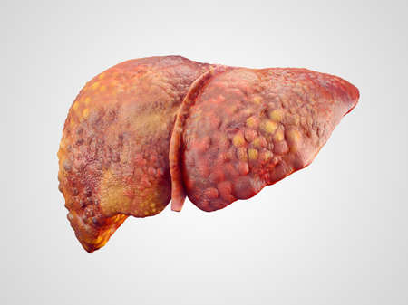 Realistic illustration of cirrhosis of human liver isolated on whiteの写真素材