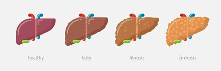 Flat design illustration of human liver damage stagesのイラスト素材