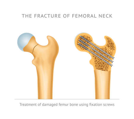 The fracture of femoral neck. Treatment of damaged femur bone neck using fixation screwsのイラスト素材