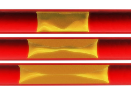 artery blockageの写真素材