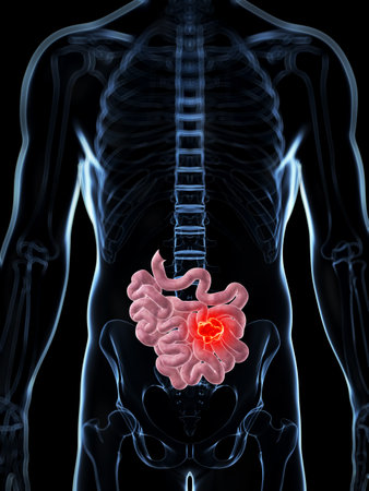 3d rendered illustration of the male small intestine - cancer