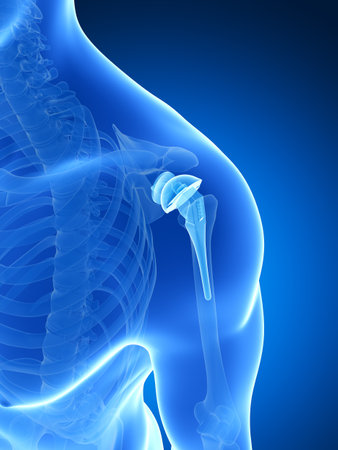 3d rendered illustration of a shoulder replacementの写真素材