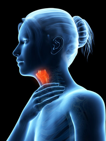 medical illustration of a female with an inflamed larynx