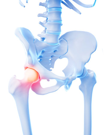 medical 3d illustration of a painful hip jointの写真素材
