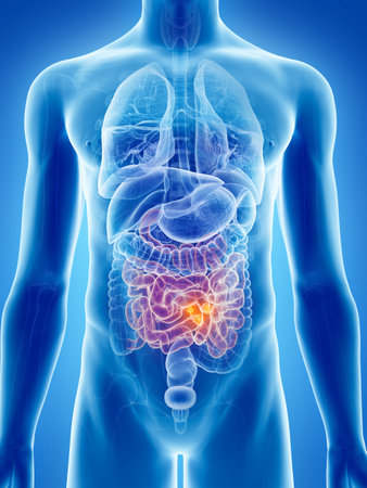 3d rendered, medically accurate illustration of small intestine cancer