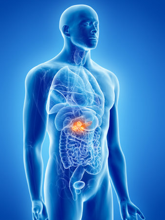 3d rendered, medically accurate illustration of pancreas cancer