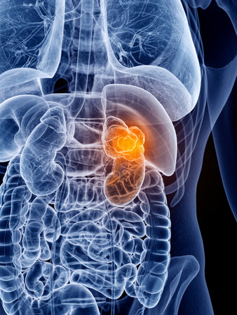 3d rendered, medically accurate illustration of kidney cancerの写真素材