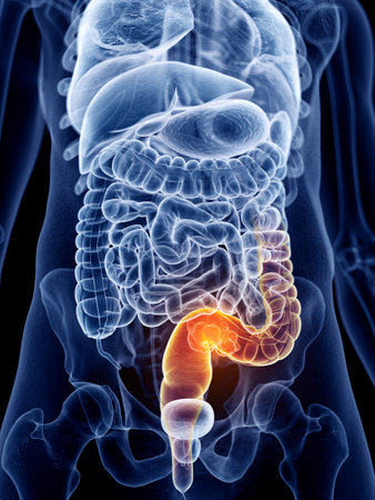 3d rendered, medically accurate illustration of bowel cancer