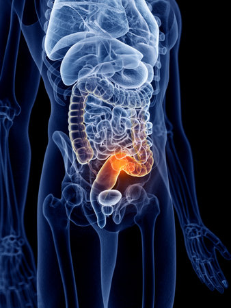 3d rendered, medically accurate illustration of bowel cancer